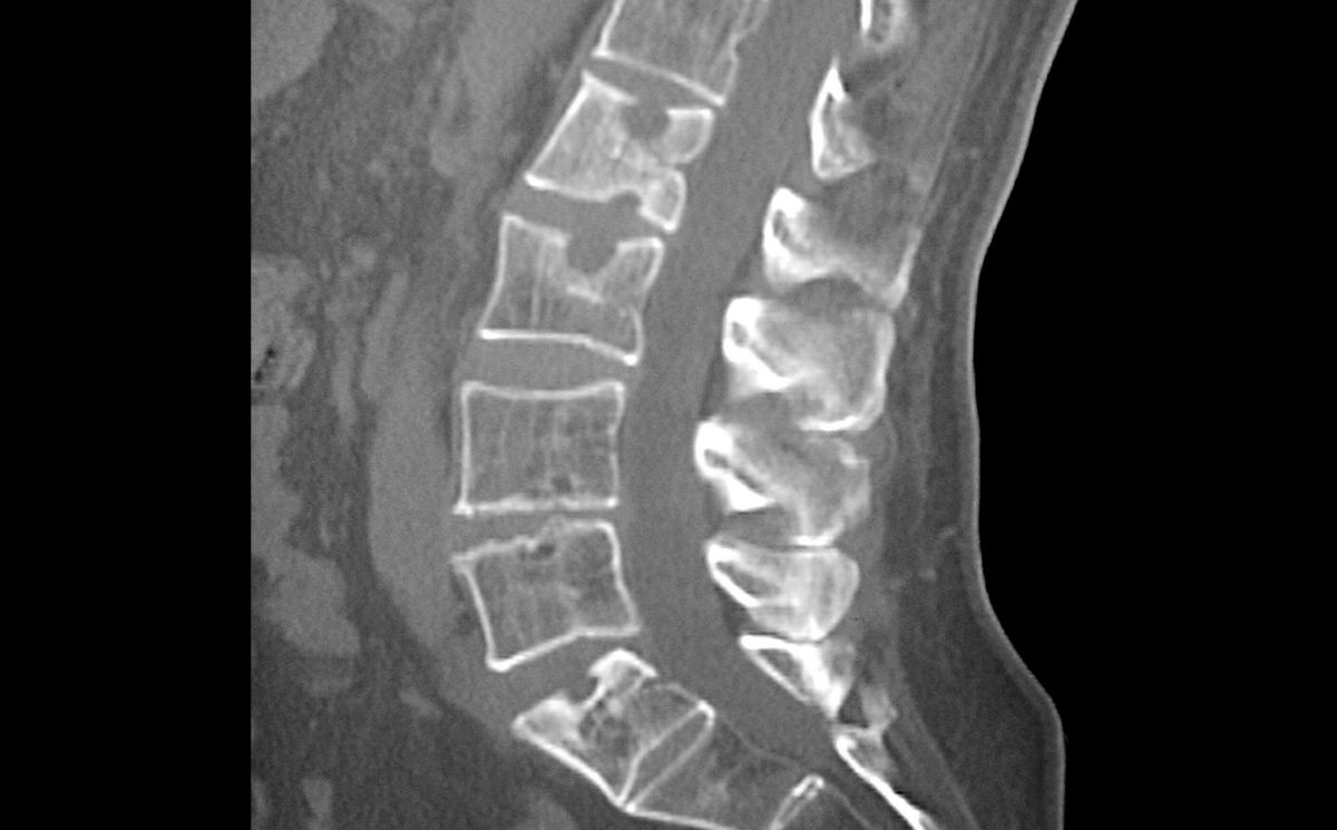 Is Your Back Pain Arthritis? The Orthopaedic Therapy Clinic